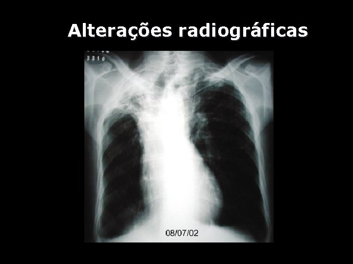 Alterações radiográficas 