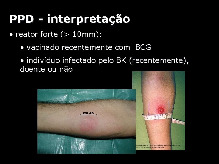 PPD - interpretação • reator forte (> 10 mm): • vacinado recentemente com BCG