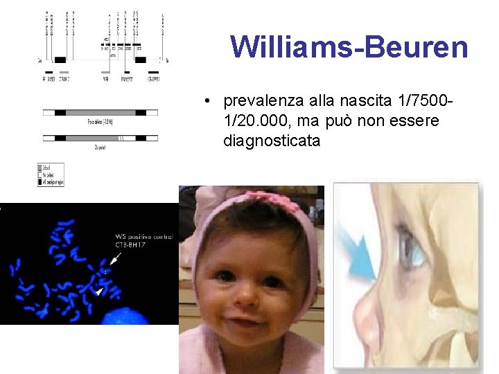 Williams-Beuren • prevalenza alla nascita 1/75001/20. 000, ma può non essere diagnosticata 