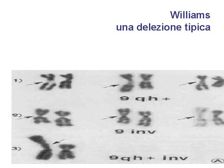 Williams una delezione tipica 