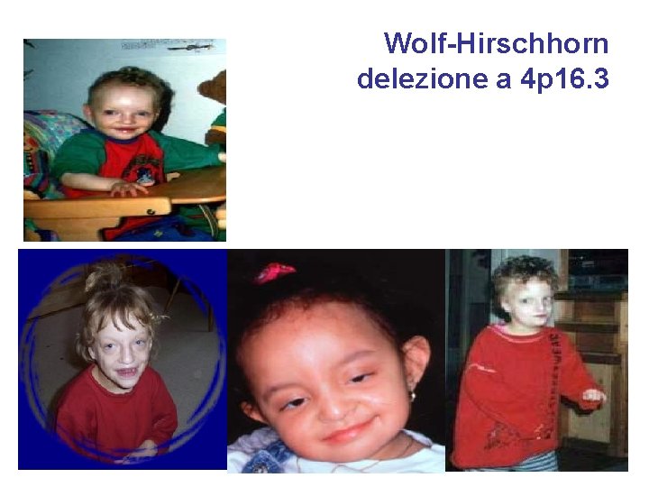 Wolf-Hirschhorn delezione a 4 p 16. 3 