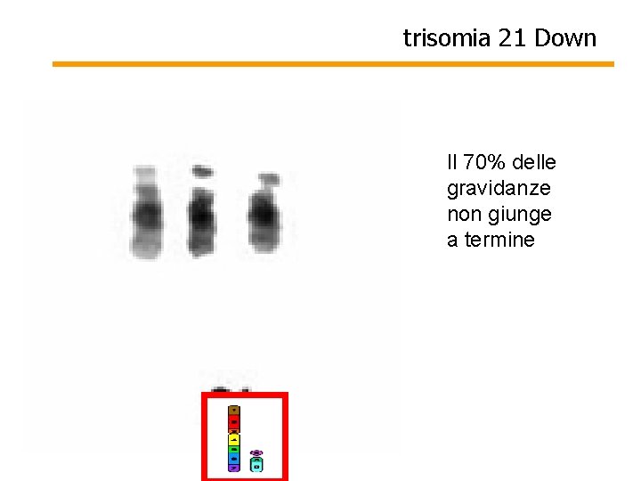 trisomia 21 Down Il 70% delle gravidanze non giunge a termine 