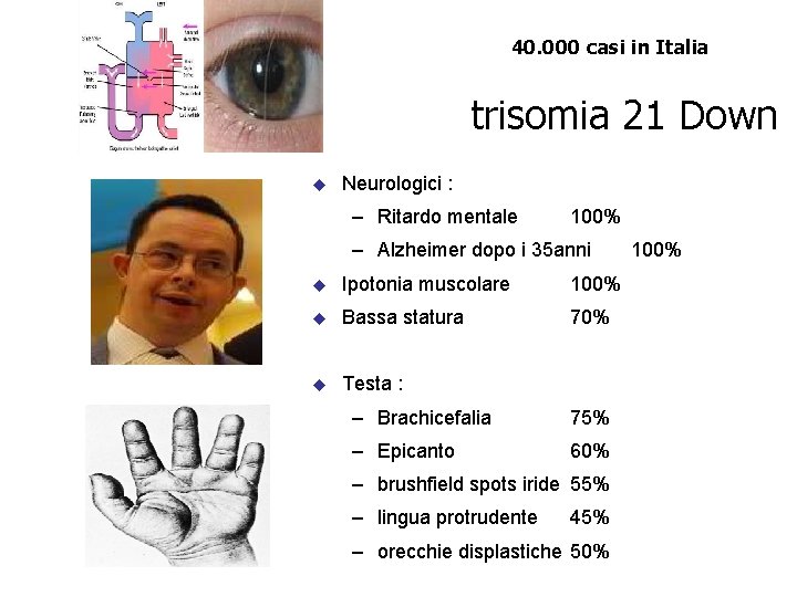 40. 000 casi in Italia trisomia 21 Down u Neurologici : – Ritardo mentale