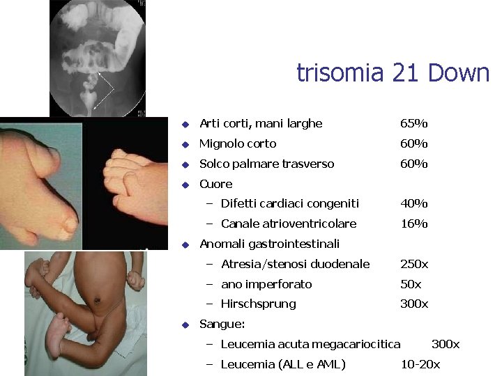 trisomia 21 Down u Arti corti, mani larghe 65% u Mignolo corto 60% u