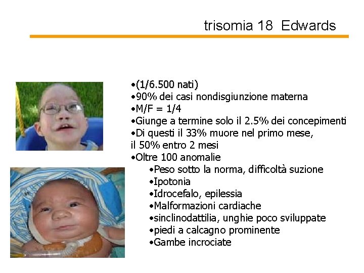 trisomia 18 Edwards • (1/6. 500 nati) • 90% dei casi nondisgiunzione materna •