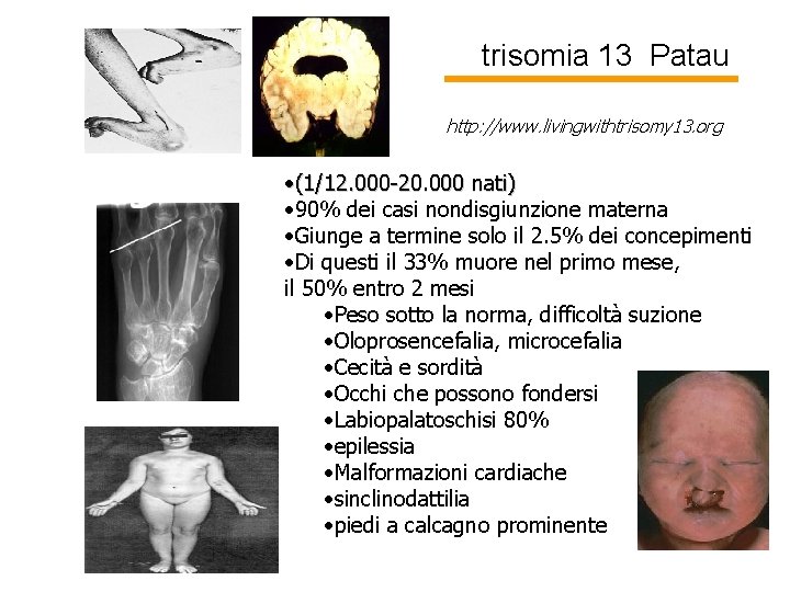 trisomia 13 Patau http: //www. livingwithtrisomy 13. org • (1/12. 000 -20. 000 nati)