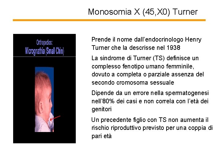 Monosomia X (45, X 0) Turner Prende il nome dall’endocrinologo Henry Turner che la
