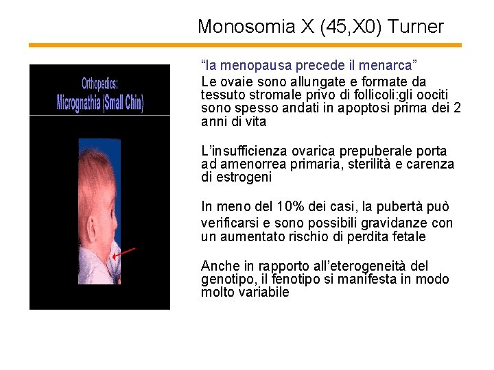 Monosomia X (45, X 0) Turner “la menopausa precede il menarca” Le ovaie sono