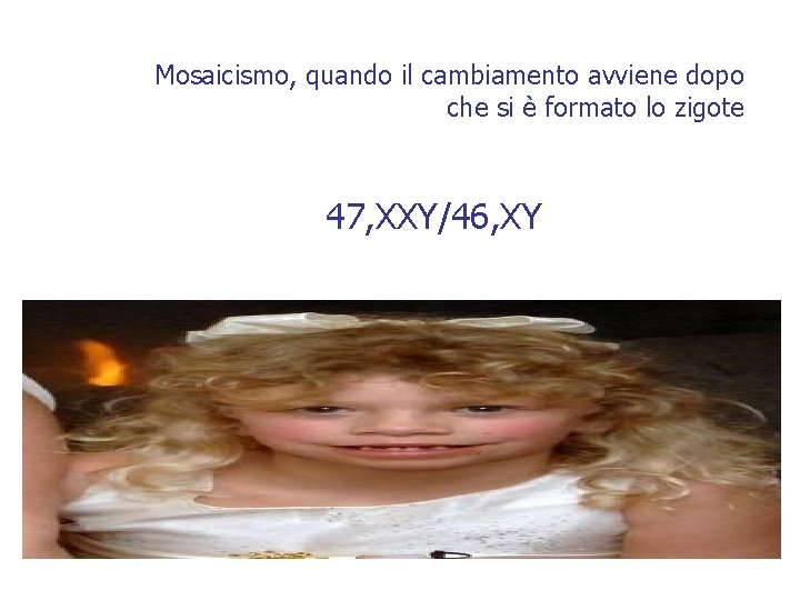 Mosaicismo, quando il cambiamento avviene dopo che si è formato lo zigote 47, XXY/46,
