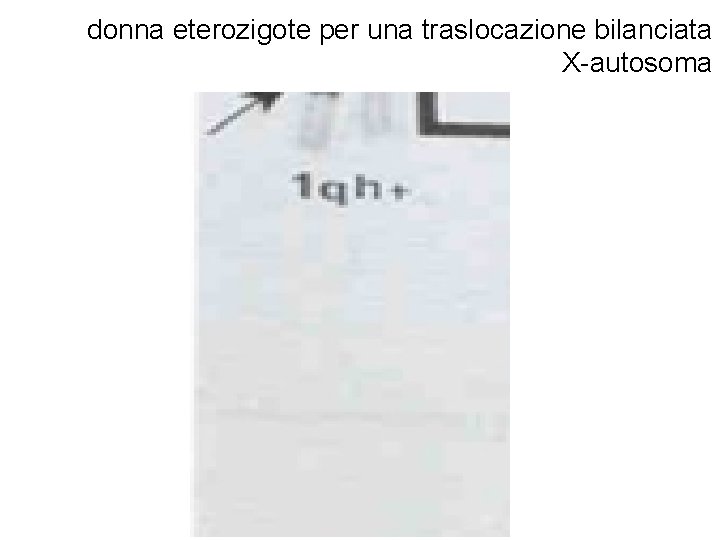 donna eterozigote per una traslocazione bilanciata X-autosoma 