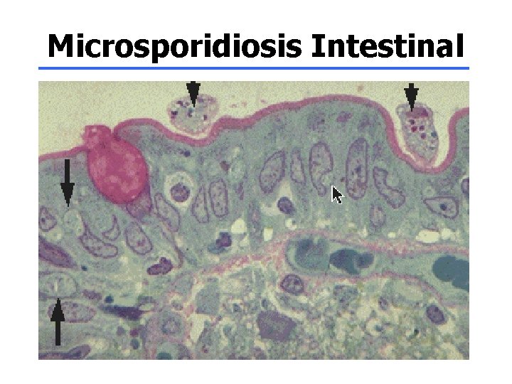 Microsporidiosis Intestinal 