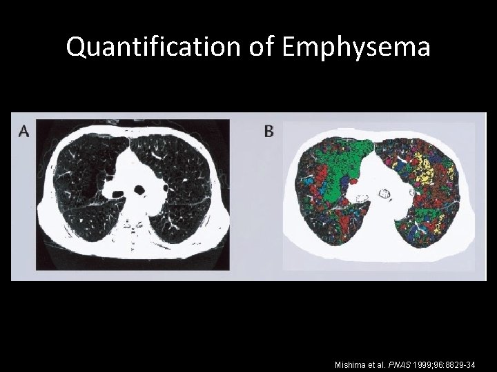 Quantification of Emphysema Mishima et al. PNAS 1999; 96: 8829 -34 