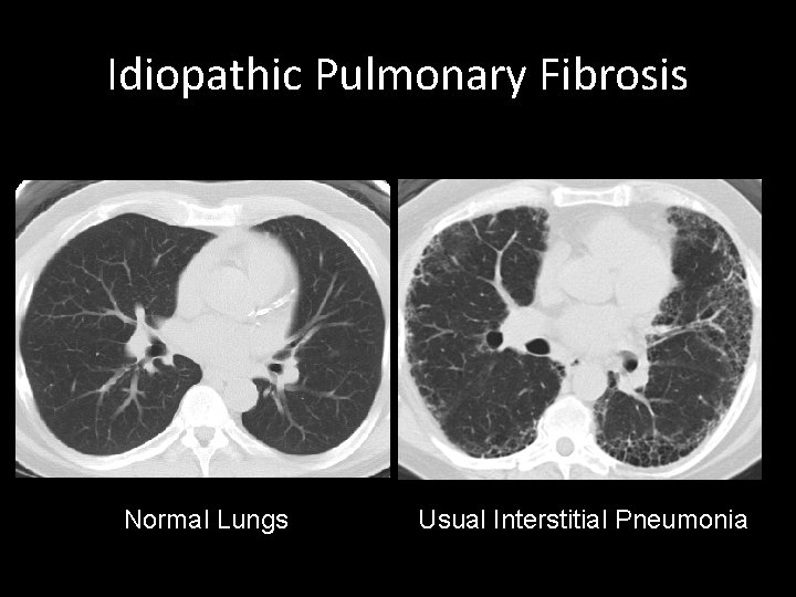 Idiopathic Pulmonary Fibrosis Normal Lungs Usual Interstitial Pneumonia 