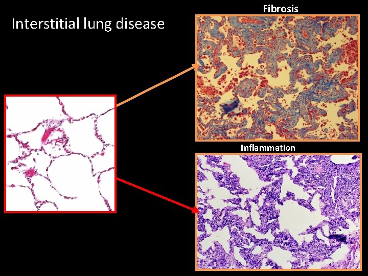 Interstitial lung disease Fibrosis Inflammation 