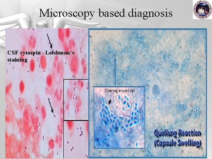 Microscopy based diagnosis CSF cytospin –Leishman’s staining 10 
