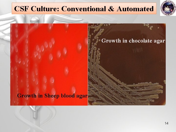 MALDI TOF analysis of Streptococcus pneumoniae from Cerebrospinal