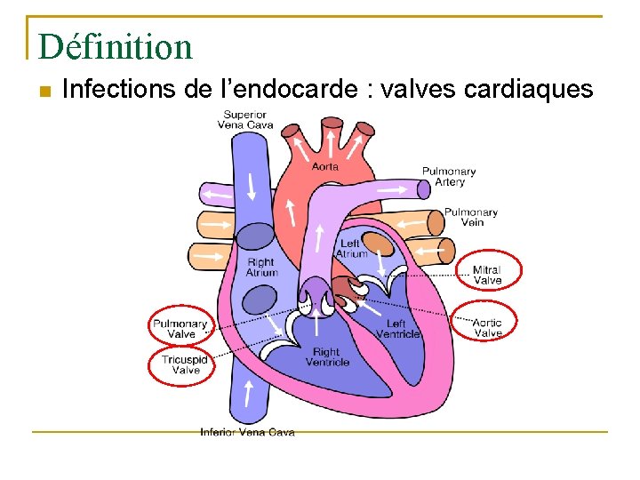 Définition Infections de l’endocarde : valves cardiaques 