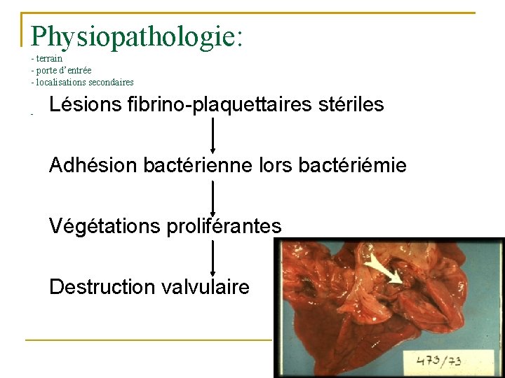 Physiopathologie: - terrain - porte d’entrée - localisations secondaires - Lésions fibrino-plaquettaires stériles Adhésion