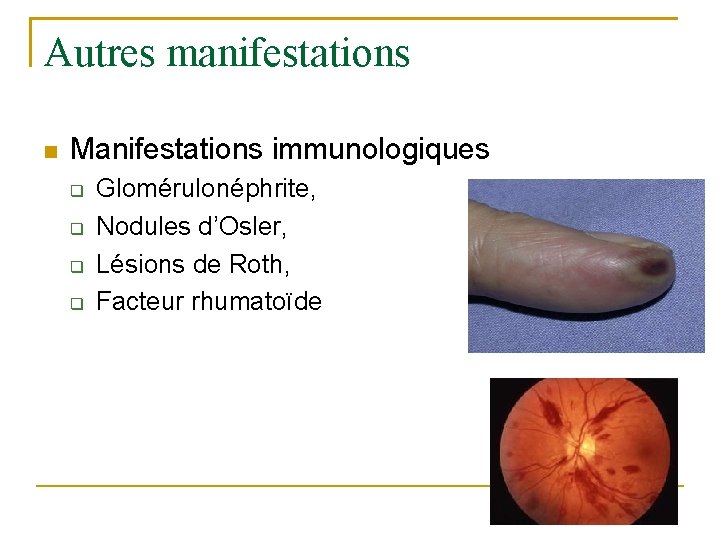 Autres manifestations Manifestations immunologiques Glomérulonéphrite, Nodules d’Osler, Lésions de Roth, Facteur rhumatoïde 