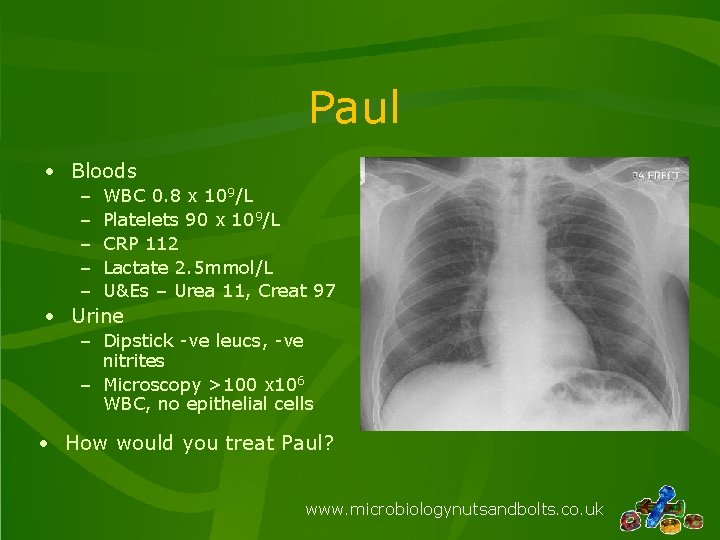 Paul • Bloods – – – WBC 0. 8 x 109/L Platelets 90 x