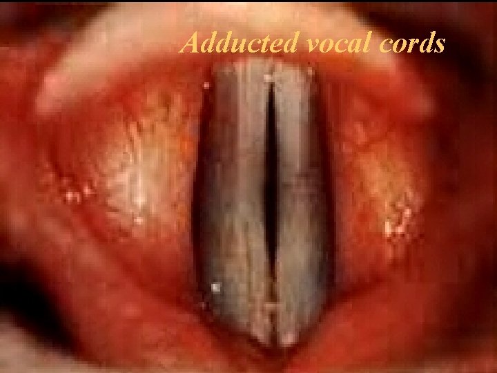 Adducted vocal cords 