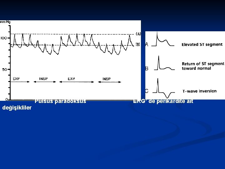  Pulsus paradoksus EKG’ de perikardite ait değişikliler 
