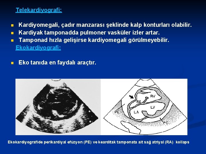 Telekardiyografi; Kardiyomegali, çadır manzarası şeklinde kalp konturları olabilir. n Kardiyak tamponadda pulmoner vasküler izler