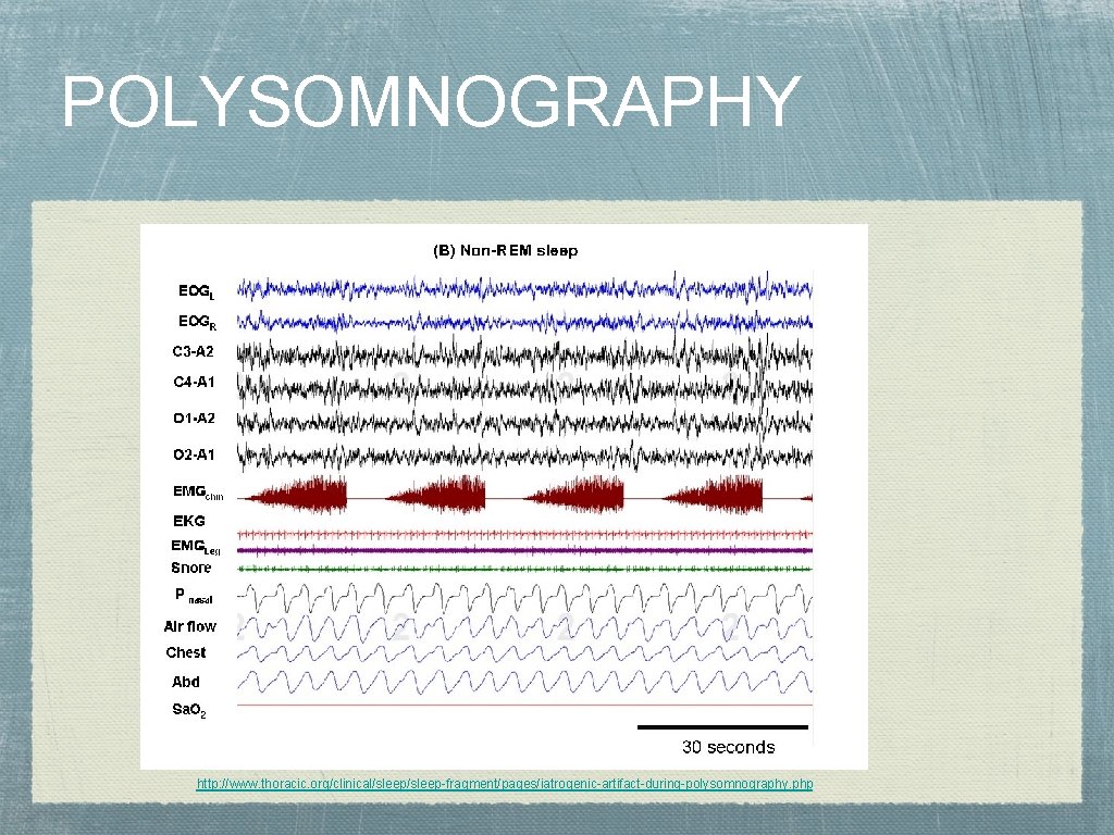 POLYSOMNOGRAPHY http: //www. thoracic. org/clinical/sleep-fragment/pages/iatrogenic-artifact-during-polysomnography. php 