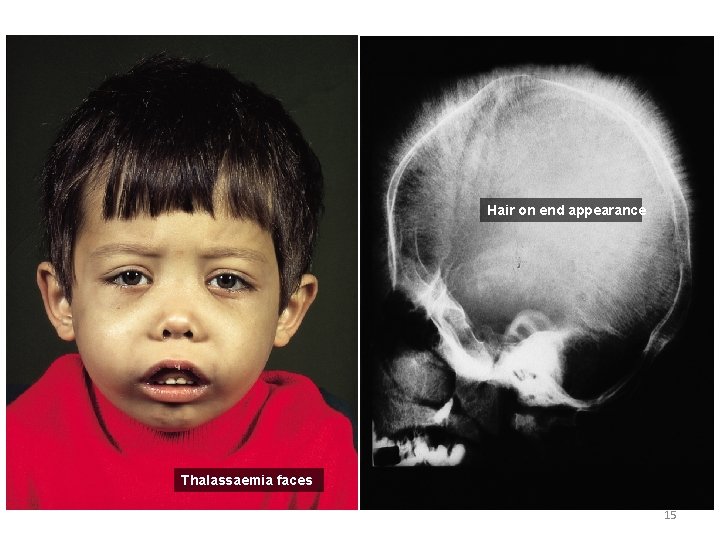 Hair on end appearance Thalassaemia faces 15 