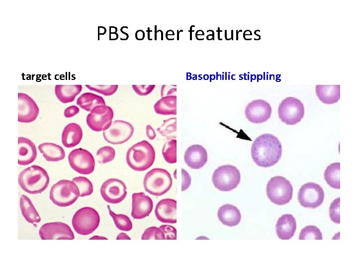 PBS other features target cells Basophilic stippling 