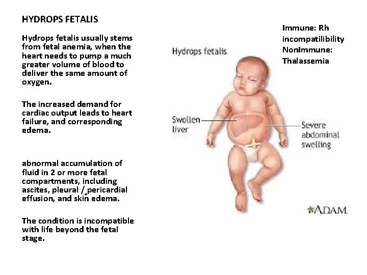 HYDROPS FETALIS Hydrops fetalis usually stems from fetal anemia, when the heart needs to