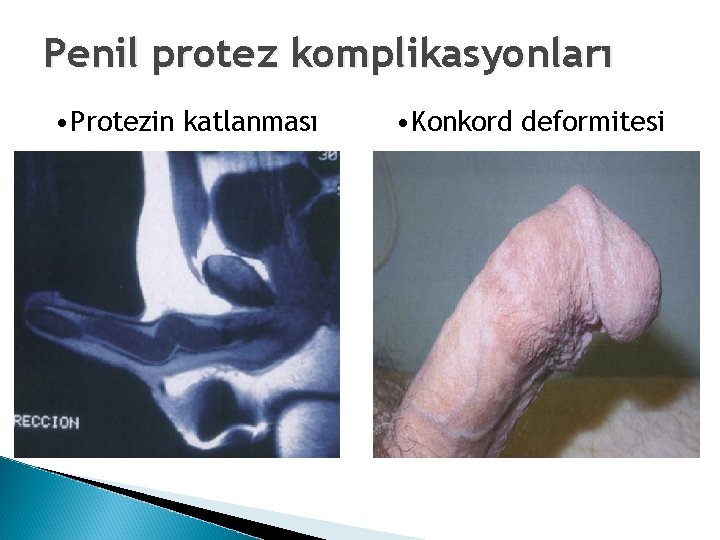 Penil protez komplikasyonları • Protezin katlanması • Konkord deformitesi 