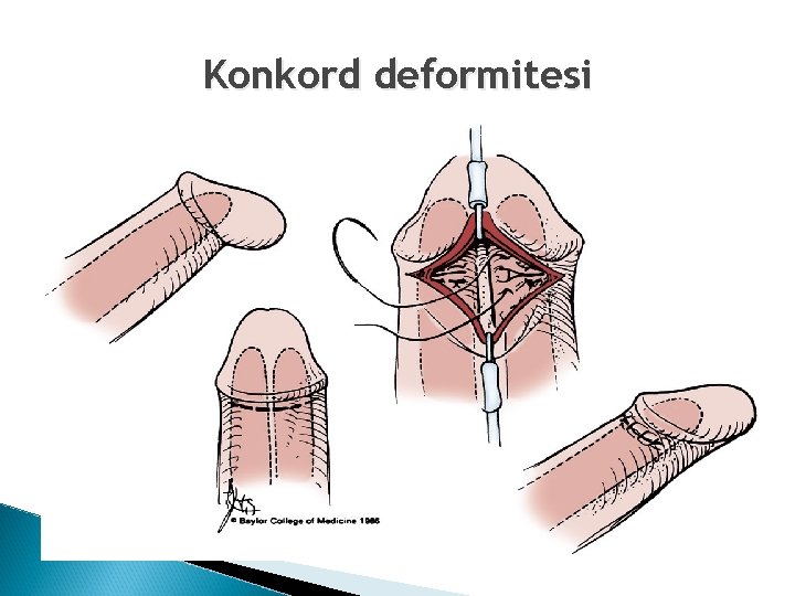 Konkord deformitesi 