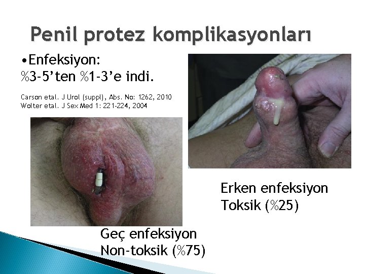Penil protez komplikasyonları • Enfeksiyon: %3 -5’ten %1 -3’e indi. Carson etal. J Urol