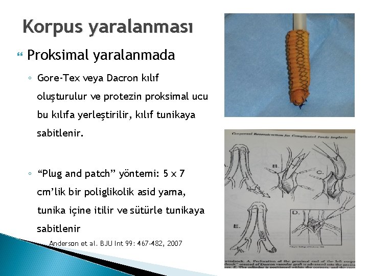 Korpus yaralanması Proksimal yaralanmada ◦ Gore-Tex veya Dacron kılıf oluşturulur ve protezin proksimal ucu