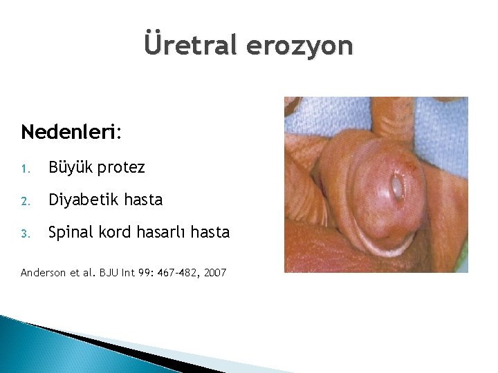 Üretral erozyon Nedenleri: 1. Büyük protez 2. Diyabetik hasta 3. Spinal kord hasarlı hasta