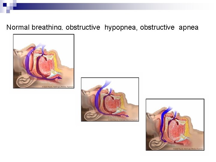 Normal breathing, obstructive hypopnea, obstructive apnea 