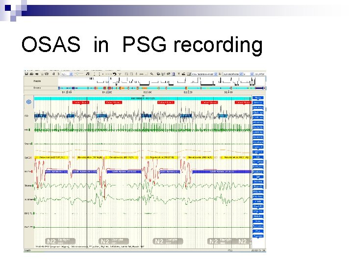 OSAS in PSG recording 