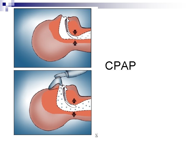  CPAP 