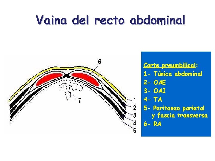 Vaina del recto abdominal Corte preumbilical: 1 - Túnica abdominal 2 - OAE 3