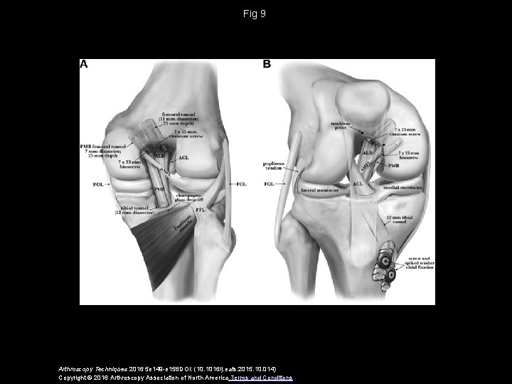 Fig 9 Arthroscopy Techniques 2016 5 e 149 -e 156 DOI: (10. 1016/j. eats.