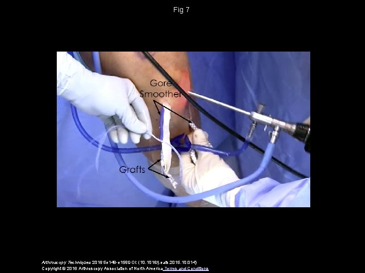 Fig 7 Arthroscopy Techniques 2016 5 e 149 -e 156 DOI: (10. 1016/j. eats.