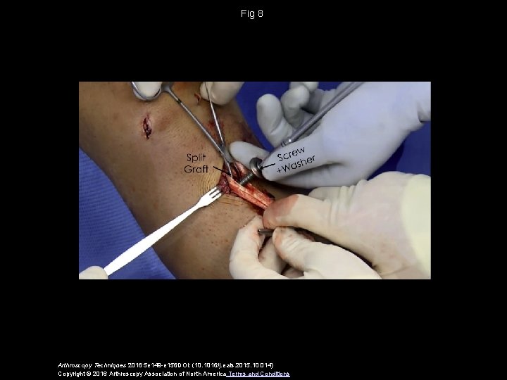 Fig 8 Arthroscopy Techniques 2016 5 e 149 -e 156 DOI: (10. 1016/j. eats.