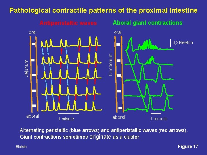 Pathological contractile patterns of the proximal intestine Antiperistaltic waves Aboral giant contractions oral Jejunum