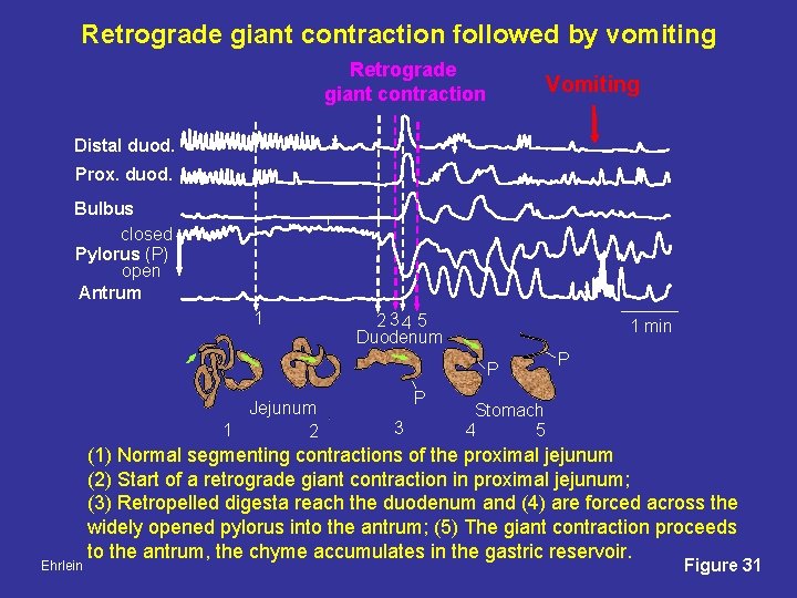 Retrograde giant contraction followed by vomiting Retrograde giant contraction Vomiting Distal duod. Prox. duod.