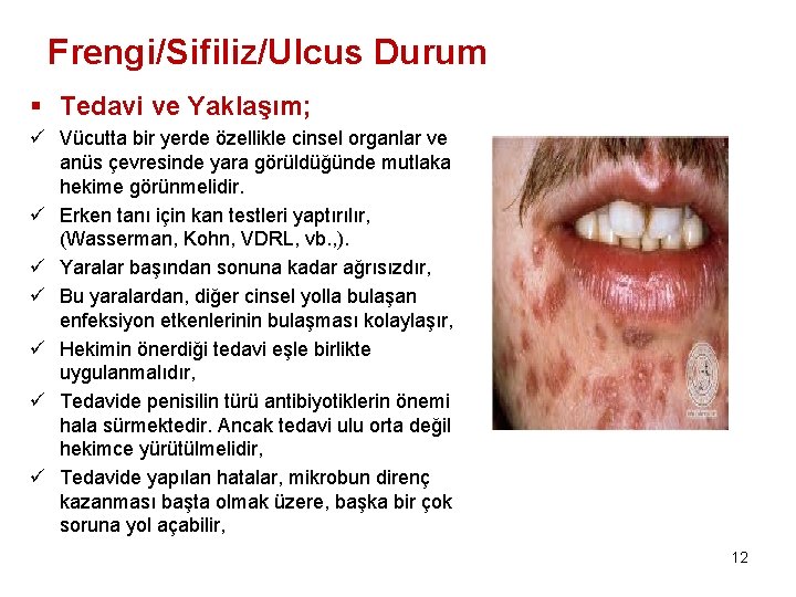 Frengi/Sifiliz/Ulcus Durum § Tedavi ve Yaklaşım; ü Vücutta bir yerde özellikle cinsel organlar ve