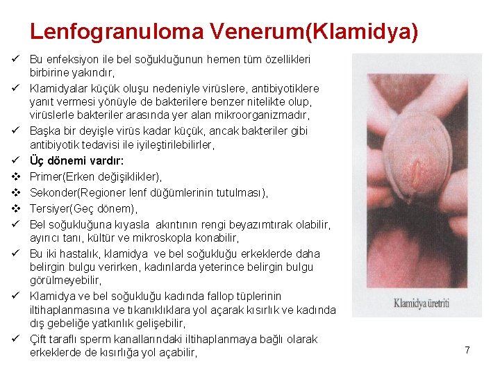 Lenfogranuloma Venerum(Klamidya) ü Bu enfeksiyon ile bel soğukluğunun hemen tüm özellikleri birbirine yakındır, ü