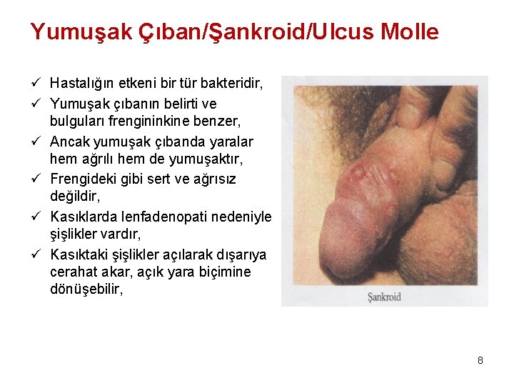 Yumuşak Çıban/Şankroid/Ulcus Molle ü Hastalığın etkeni bir tür bakteridir, ü Yumuşak çıbanın belirti ve