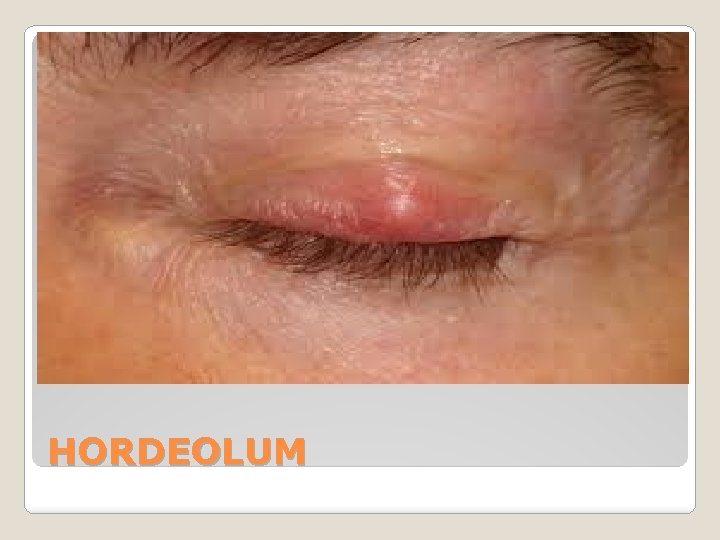 HORDEOLUM 