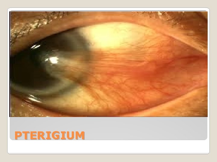 PTERIGIUM 